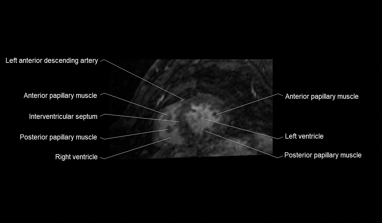 MRI heart and coronary arteries short axis anatomy image 31.webp